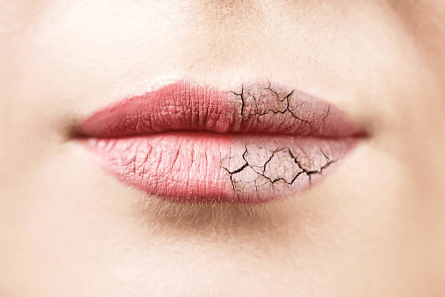Чому сохнуть і печуть губи: причини та вирішення проблеми у 2025 році Чому сохнуть і печуть губи: причини та вирішення проблеми у 2025 році